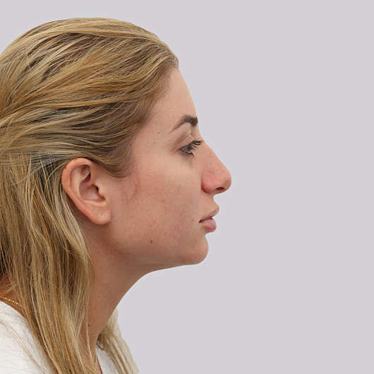Dr Ha Revision Rhinoplasty Before & After - Adelaide
